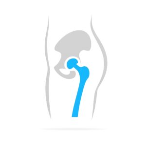 6 mesečni rehabilitacijski program vaj po operaciji, zamenjavi kolka